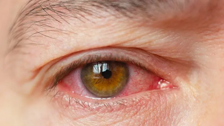 Ayurvedic management of Shushkakshipaka (dry eye syndrome): clinical insights into Keshanjana, Netra Parisheka, and Tarpana therapies